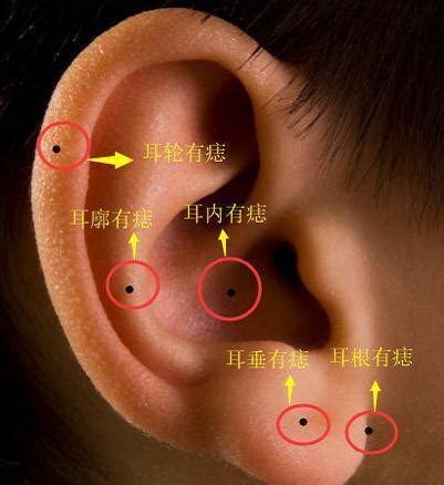 耳朵有痣可以打耳洞嗎